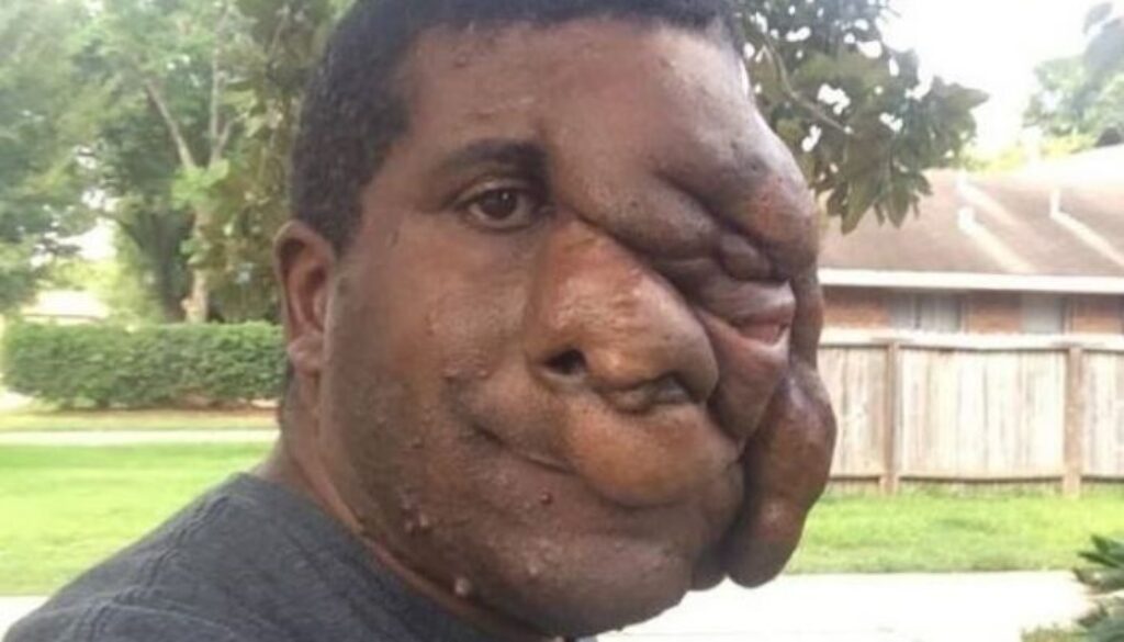 neurofibromatosi.jpg