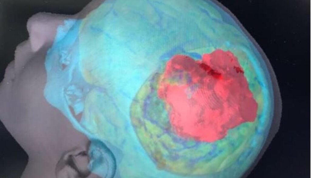 cranio-tumore.jpg cranio-tumore.jpg