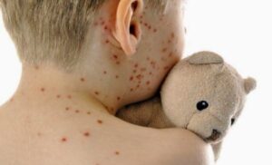 Decine di casi di morbillo in Usa, Bassetti: “Persa copertura vaccinale guadagnata in 40 anni”